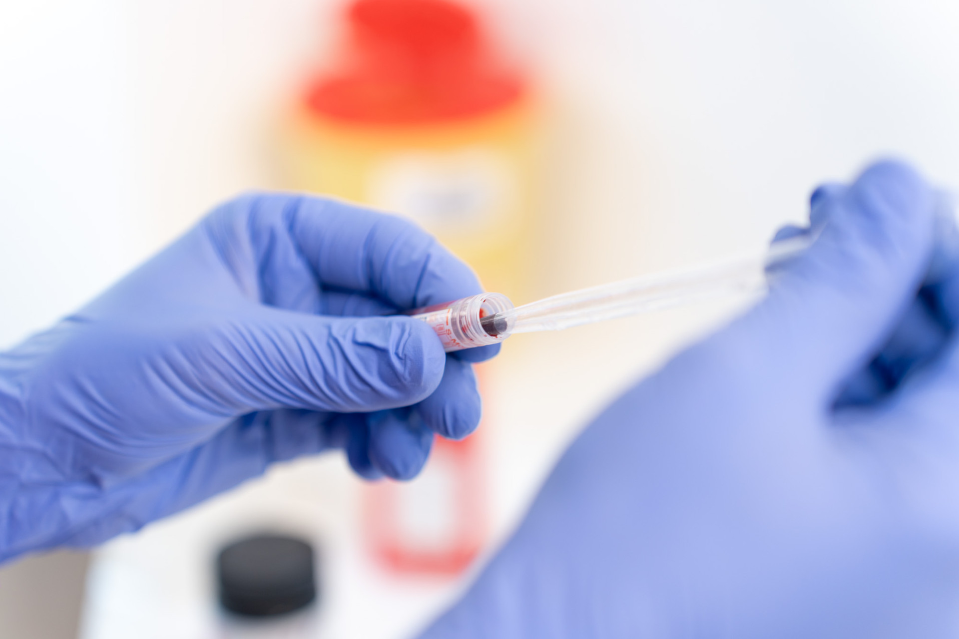 Hände mit Handschuhen entnehmen medizinische Probe mittels Pipette aus Reagenzglas